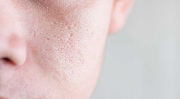 The Ultimate Guide: 5 At-Home Solutions to Smooth Out Scarred Skin