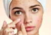 The 3 Severe Consequences of Popping Pimples