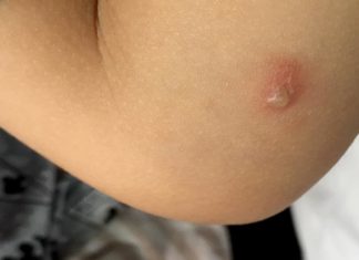 The Tricky Trio: Identifying, Treating, and Preventing Bites from the Brown Marmorated Stink Bug