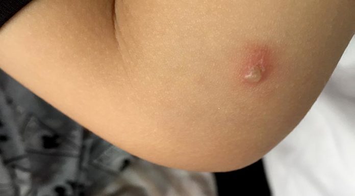 The Tricky Trio: Identifying, Treating, and Preventing Bites from the Brown Marmorated Stink Bug