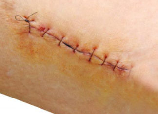 Why You Should Avoid Eating Sticky Rice Dishes When You Have a Wound.