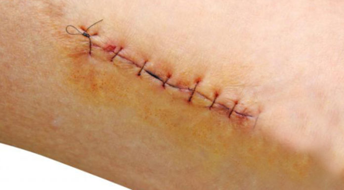 Why You Should Avoid Eating Sticky Rice Dishes When You Have a Wound.