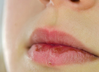 What’s the Damage: The Lip-Licking Habit in Cold Weather