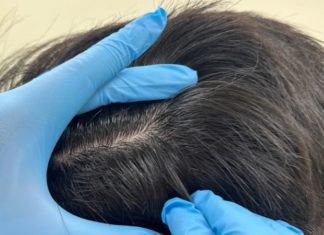 Does the Habit of Pulling Out Gray Hairs Harm the Scalp?