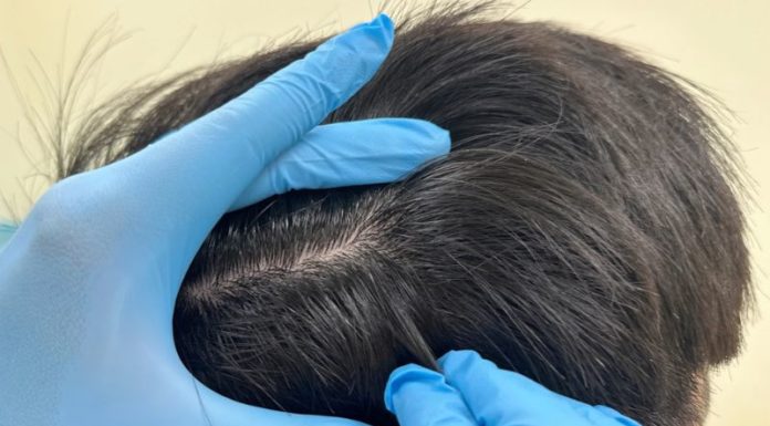Does the Habit of Pulling Out Gray Hairs Harm the Scalp?