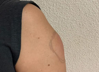 What Side Effects Can Children Experience After Receiving the COVID-19 Vaccine?