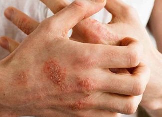 The Symptoms and Effective Prevention of Weather Allergies