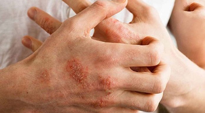 The Symptoms and Effective Prevention of Weather Allergies