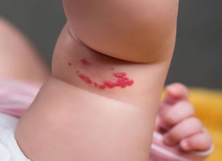 What Do Red Birthmarks Mean for Your Destiny?