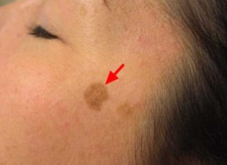 The Ultimate Guide: 6 Ways to Fade Age Spots Fast