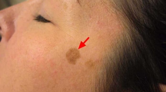 The Ultimate Guide: 6 Ways to Fade Age Spots Fast