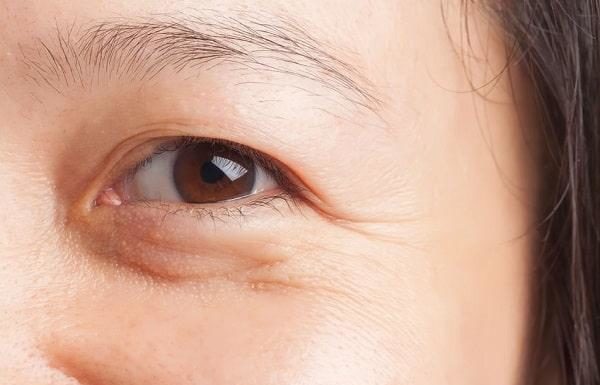 The Ultimate Guide: Smooth Out Crow’s Feet and Banish Eye Wrinkles