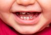 Why Are My Child’s Teeth Turning Black? Understanding and Addressing Childhood Black Teeth.