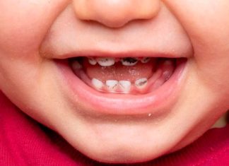 Why Are My Child’s Teeth Turning Black? Understanding and Addressing Childhood Black Teeth.