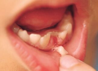 “Pain-Free DIY Baby Tooth Extraction”
