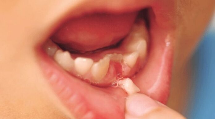 “Pain-Free DIY Baby Tooth Extraction”