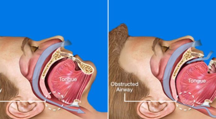 “Nutrition for a Good Night’s Sleep: Eating Healthy to Combat Sleep Apnea”