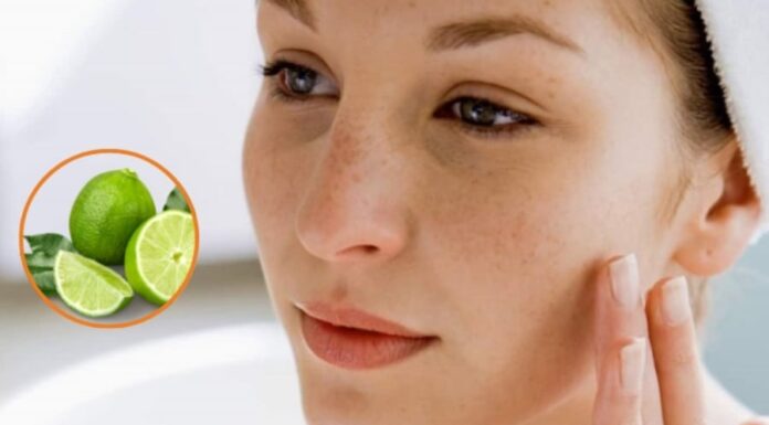5 Natural Remedies for Freckles: Simple and Effective Solutions