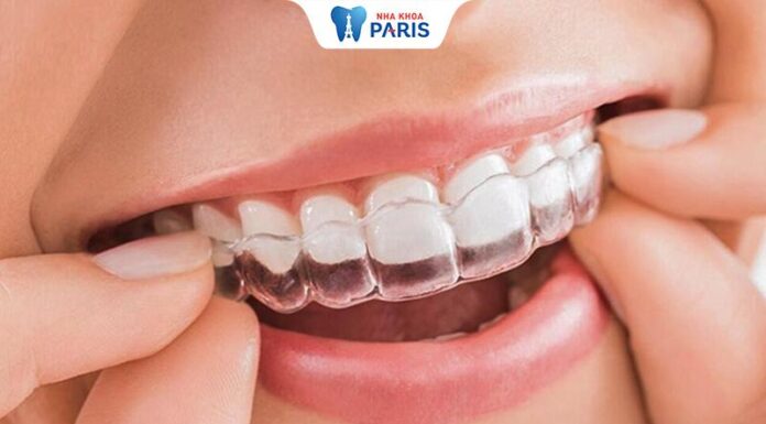 The Cost of Invisalign: A Comprehensive Guide