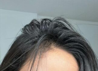 “From Skin Struggles to Flawless: H’Hen Niê’s Journey to Radiant Skin”