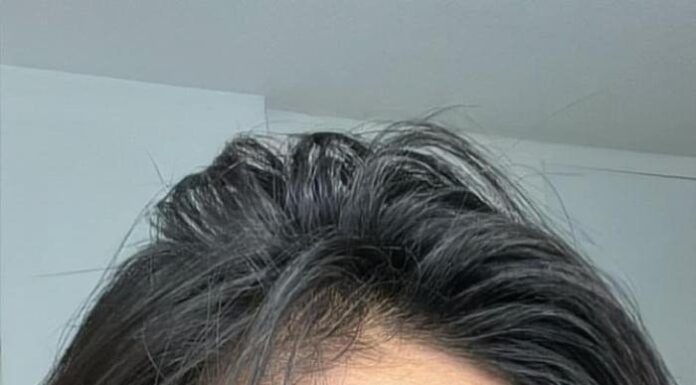 “From Skin Struggles to Flawless: H’Hen Niê’s Journey to Radiant Skin”