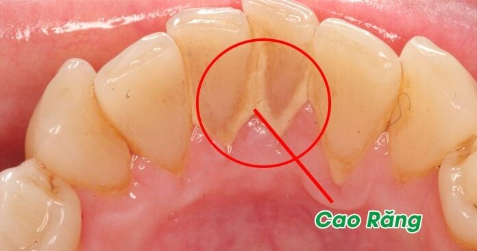 “Get Rid of Unsightly Plaque: A Simple Method for Sparkling, Healthy Teeth”