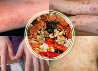 The Ultimate Guide to Combating Seafood Allergies