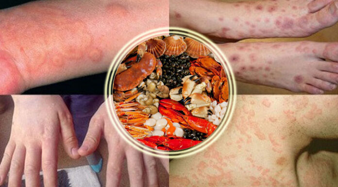 The Ultimate Guide to Combating Seafood Allergies