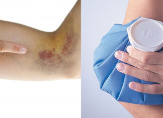 11 Quick, Easy, and Effective Home Remedies to Get Rid of Bruises