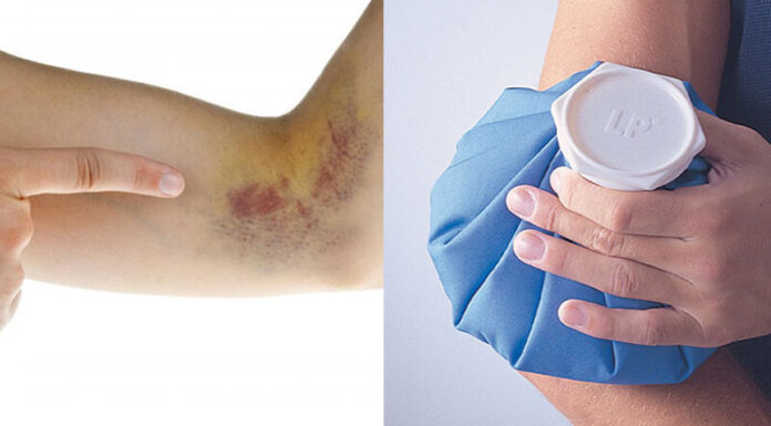 11 Quick, Easy, and Effective Home Remedies to Get Rid of Bruises