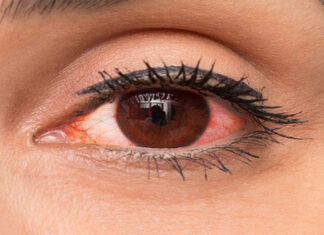 Some Common Issues When Wearing Contact Lenses for the First Time