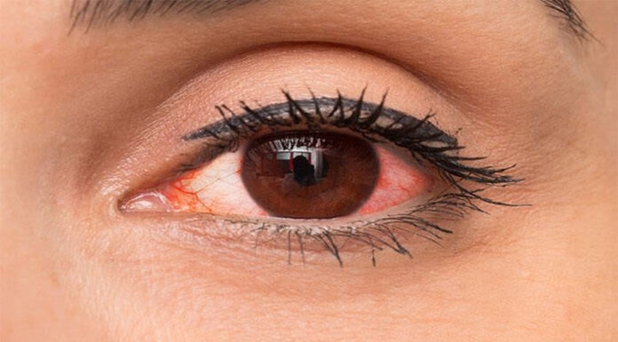 Some Common Issues When Wearing Contact Lenses for the First Time