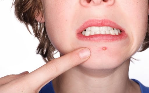 The 4 Types of Pimples You Should Never Pop: A Guide to Avoiding Skin Damage, Infections, and Scars