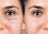 6 Ways to Prevent Eye Wrinkles and Drastically Improve Dark Circles