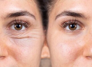 6 Ways to Prevent Eye Wrinkles and Drastically Improve Dark Circles
