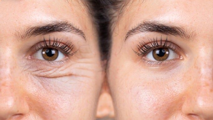 6 Ways to Prevent Eye Wrinkles and Drastically Improve Dark Circles