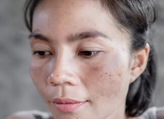 The Secret to Diminishing Post-Pregnancy Skin Discoloration: Unveiling Effective Strategies for Radiant Skin