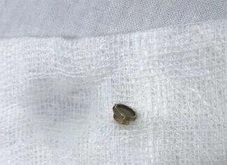 The Dangers of Sleeping With Earphones: A Narrow Escape From Ruptured Eardrums