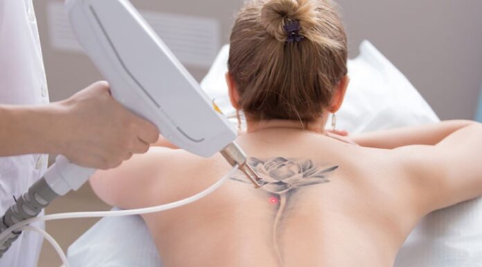 Does Tattoo Removal Hurt? 5+ Home Remedies to Remove Tattoos