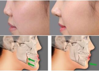 What is Mewing? How Can Mewing Help Women Achieve a Slimmer, More Defined Face Like a Korean Beauty?