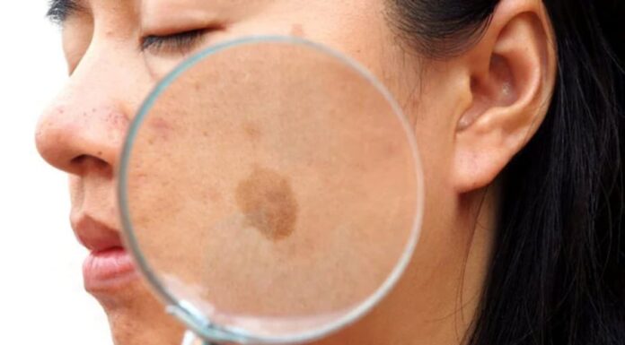 3 Simple Ways to Fade Liver Spots at Home