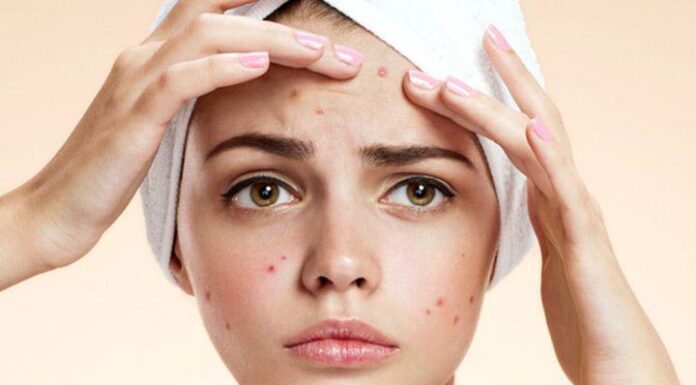 “The Acne Enigma: Unveiling the Secret to Clear Skin”