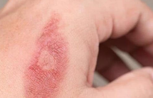 The Do’s and Don’ts of First Aid for Burns: 5 Crucial Steps to Take