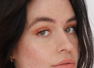 “Should You Apply Sunscreen on Acne-Prone Skin? Expert-Backed Secrets Revealed”