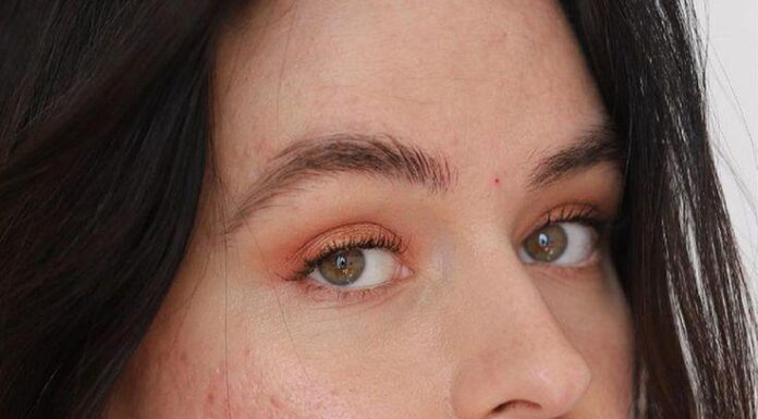 “Should You Apply Sunscreen on Acne-Prone Skin? Expert-Backed Secrets Revealed”