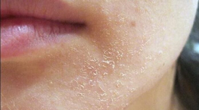 6 Ways to Combat Flaky Skin and Restore a Youthful, Glowing Complexion