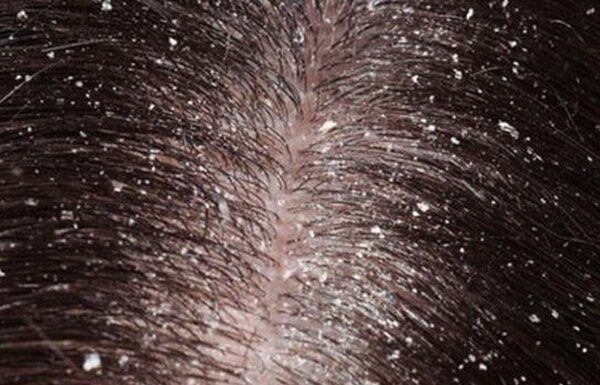 5 Natural Home Remedies to Fight Dandruff and Get Smooth Hair This Fall