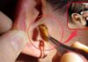 Why Do Some People Have Wet Earwax While Others Have Dry Earwax?