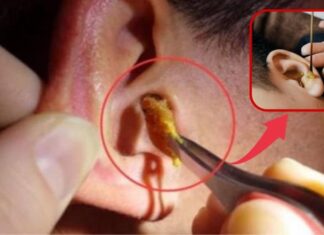 Why Do Some People Have Wet Earwax While Others Have Dry Earwax?