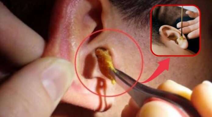 Why Do Some People Have Wet Earwax While Others Have Dry Earwax?